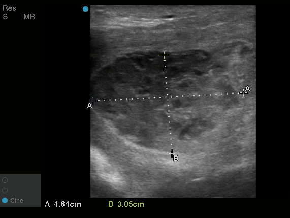 ultrasound of a mass